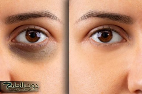 مكون سحري لن تتوقعيه.. علاج نهائي للهالات السوداء في دقائق
