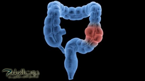 ضاع عمرنا واحنا منعرفش أنها كنز كبير .. العشبة الخارقة لتنظيف القولون وتطهير الأمعاء من البراز المتحجر