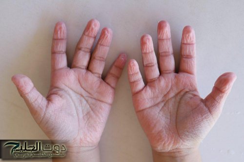 علماء يكتشفون السبب الحقيقي لتجعد الأصابع عند نقعها أو بعد الاستحمام