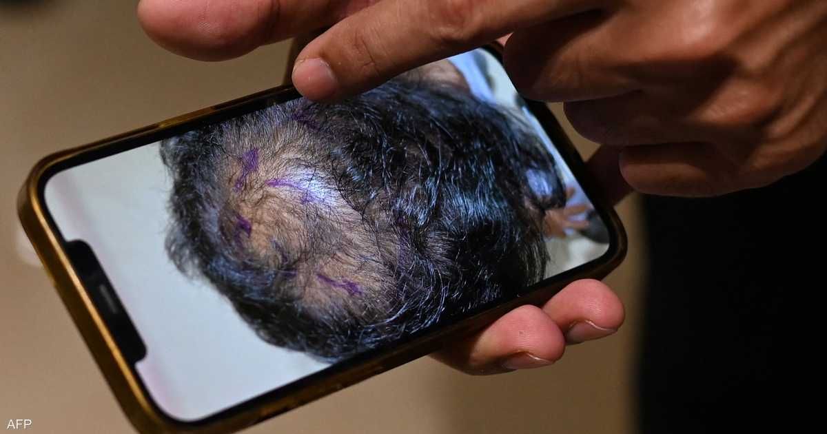 العالم اليوم - ابتكار مصل لعلاج تساقط الشعر في قرابة 20 يوما