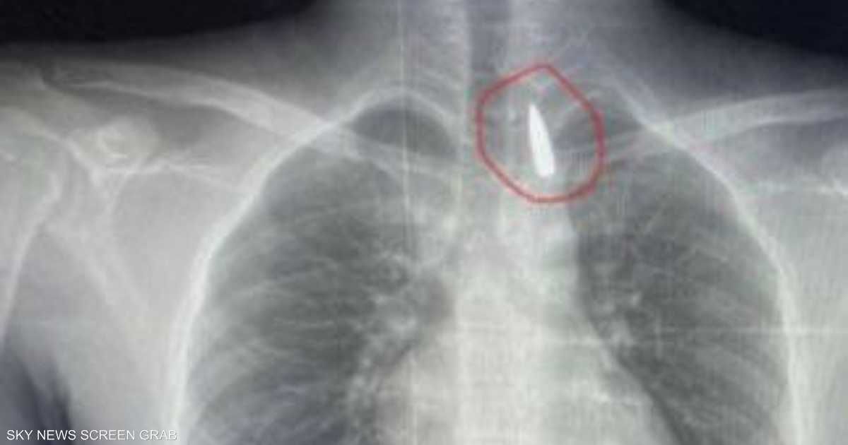 العالم اليوم - مقذوف استقر في صدره.. إنقاذ حياة مصاب من غزة في مصر