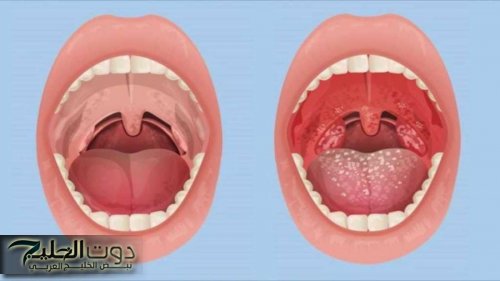 التهاب البلعوم .. الأسباب والتشخيص والعلاج