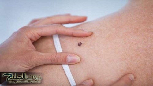 أوعى تتجاهلها.. ظهور هذه العلامة على جسمك يشير للإصابة بمرض السرطان