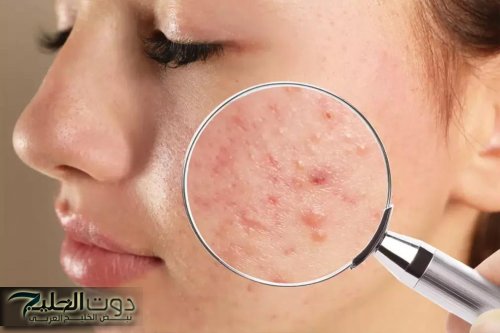 خطوات بسيطة للتخلص من حب الشباب وآثاره نهائيا
