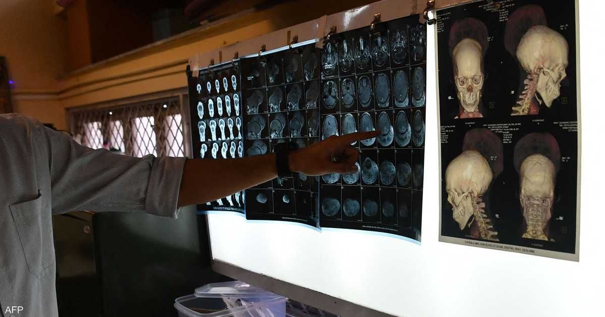 العالم اليوم - دراسات تكشف علاقة "مقلقة" بين الاكتئاب والصرع