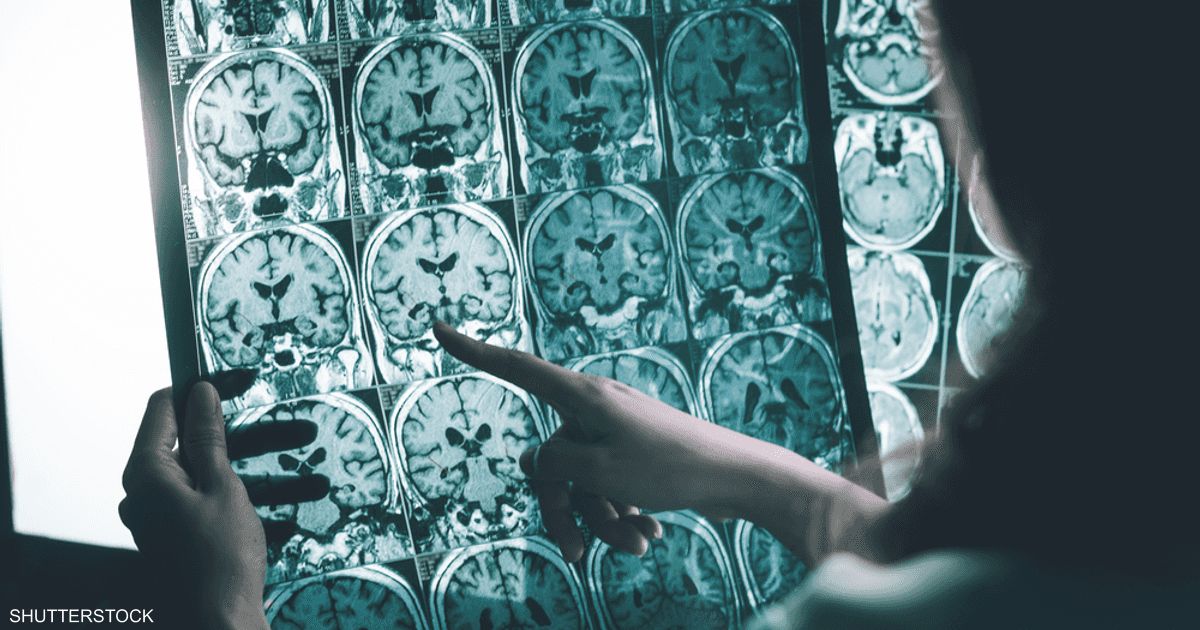 العالم اليوم - مرحلة ما قبل الأعراض.. دواء جديد يستهدف "شرارة" الزهايمر