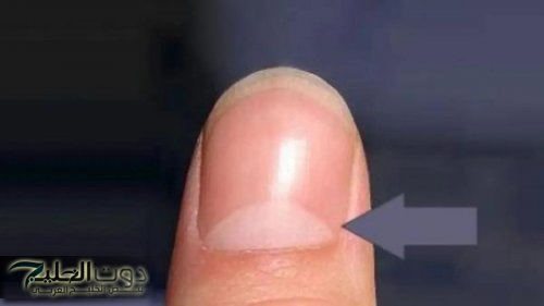 اعرف جسمك.. الهلال الأبيض الموجود حول أظافرك يكشف عن صحتك