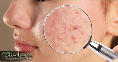 هتخليها منورة.. طريقة فعالة تخلصك من بثور البشرة واستعادة نضارتها