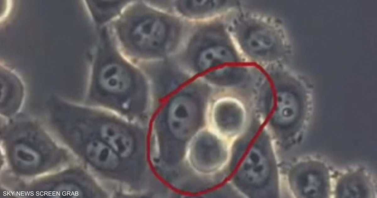 العالم اليوم - كشف سرطان البنكرياس.. "باندا" تتفوق على الأطباء