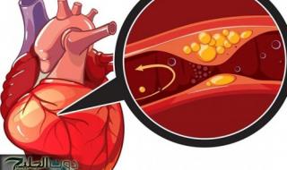 حسام موافي يحذر: هذه الأمراض تسبب ضيق الشريان التاجي