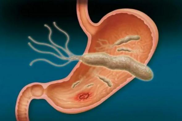 جرثومة المعدة: هل انتهت المعركة؟ تعرف على الأسباب التي تدعوك لتكرار العلاج وكيفية الوقاية