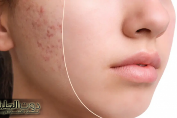 وصفة زيت اليوسفي المدهشة.. أفضل علاج لـ حب الشباب والندبات وأقوى من سيروم C